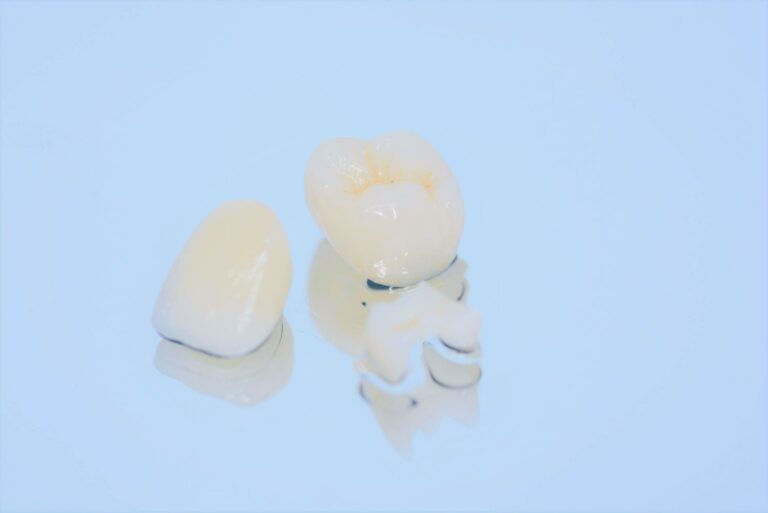 セラミック治療について