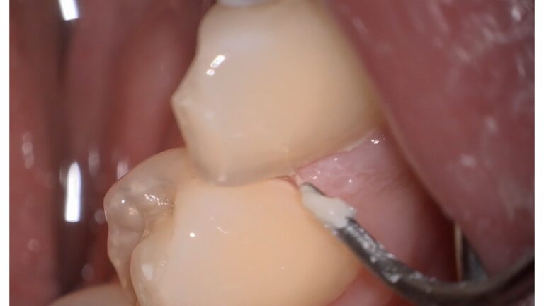 歯垢（プラーク）について